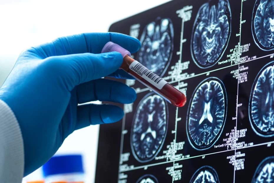 Análisis de sangre para detectar el Alzheimer: