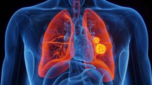 Nuevo tratamiento para prevenir el cáncer de pulmón mediante bloqueo de la caspasa-1