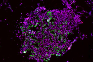Nuevo tratamiento para prevenir el cáncer de pulmón mediante bloqueo de la caspasa-1